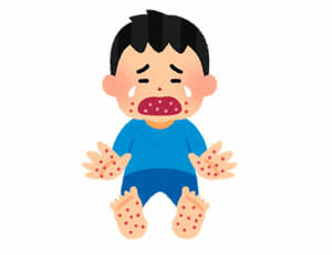 口内炎 原因 子供 口の中が口内炎だらけ！その原因と正しい対処法